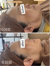 ポエマ(POEMA)/before/after