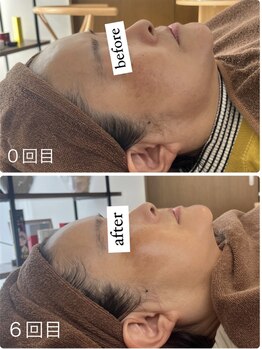 ポエマ(POEMA)/before/after