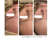 アーベル(Ar-Belle)/皮剥けなし大人気毛穴ピーリング