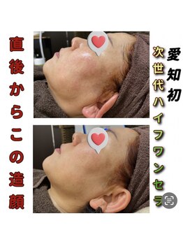 アイリー(IRIE)/インモード　ワンセラ