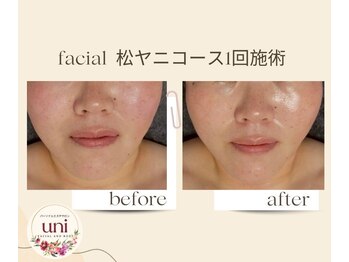 パーソナル ユニ(uni)/松ヤニプレミアム1回施術