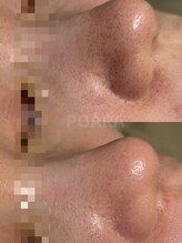 ポアラ(POARA) 毛穴迷子 卒業