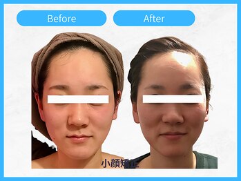 トウメイコガオ 横浜店/トウメイコガオで小顔エステ