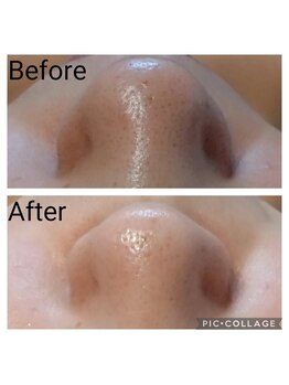 フロレゾン(Floraison)/毛穴エクストラクション