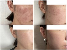 デューン 蕨店(Dune)/before/after 20代後半女性