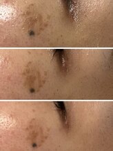 アトワ(A toi)/ハーブピーリングたった3回