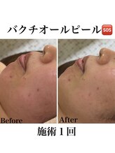 マスカレード 品川(Masquerade)/バクチオールピールSOS