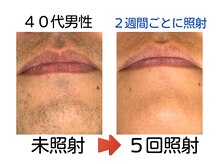 エビアス 旭川豊岡(evias)/メンズ店 5回でヒゲがこんなに！