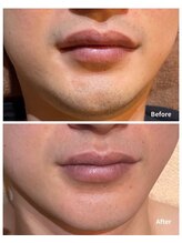 ルタンリッシュオム(Lutan Riche hom)/部分ヒゲ脱毛も可能