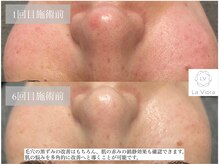 ラヴィオーラ 川崎(La Viora)/ダイヤモンドハーブピーリング