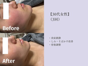 ベルペール(Belle perle)/【小顔】印象リフトフェイシャル