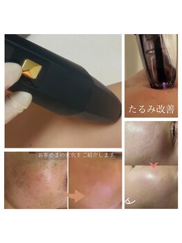 エンドット(EN.)の写真/プラズマカリファEX  美肌・肌質改善・細胞活性化・リフトアップ・シワシミ改善など多彩な美容効果○
