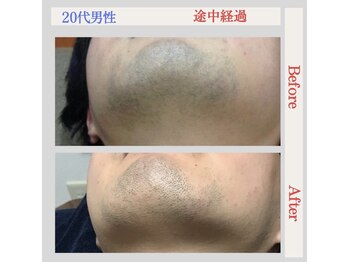 トータルケアーサロン アクア 時津(AQUA)/脱毛：ビフォーアフター５