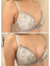 美人バスト 川崎店/バストアップ◇症例◇