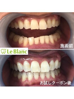ルブラン 奈良店(Le Blanc)/15分2回照射！