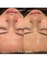 ラルーナ(LA LUNA)/和漢ハーブピーリング