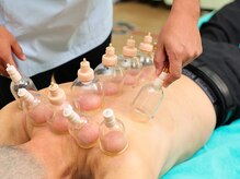 安井鍼灸接骨院 春田本院/カッピング