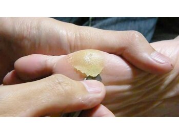 四季縁/足裏の角質、気になりませんか？