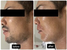 バブル(BUBRU)/髭脱毛