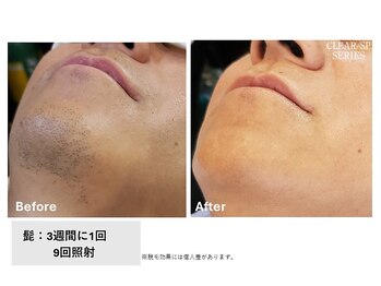 ビープランニング(B-PLANNING.)/【ヒゲ脱毛】頬＋鼻下＋首＋顎