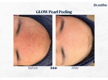 オーシャンブルー 福岡店(OCEAN BLUE フェイシャル&ボディ)/【韓国】グロウパールピーリング