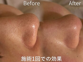 セレソル(CERESOL)/究極の毛穴洗浄《BeforeAfter》