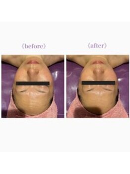 ライゼ(REISE)/ビフォーアフターご紹介【シワ】