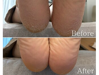 カシェット 広島店(Cachette)/50代女性☆90分足裏角質ケア