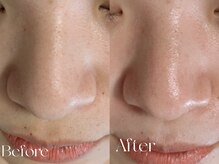 ウィハナ(wehana)/【毛穴洗浄×セラピール】