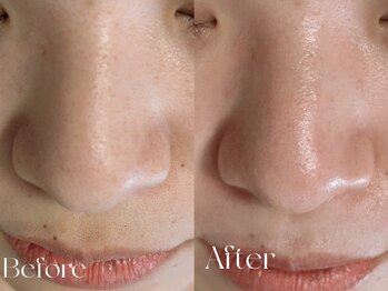 ウィハナ(wehana)/【毛穴洗浄×セラピール】