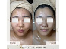 キュキュナチュレの雰囲気（ニキビ/肌荒れ/赤み/毛穴の開き/たるみ/シミシワ緩和/小顔）