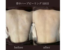 美肌ケアサロン iru 北千住店【ハーブピーリング | ララピール | 毛穴洗浄】/背中のハーブピーリング