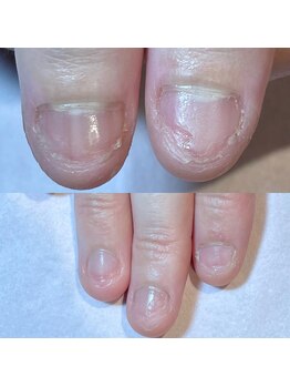 ココデネイル(cocode nail)/悩み:爪噛み(30代後半)