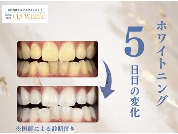 シアホワイト(CIA WHITE)/劇的ビフォーアフター