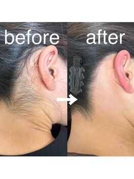 エフ ワクシングブティック(efu.WaxingBoutique)/うなじ+もみあげ¥4,500