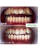 ホワイトニングサロン 名古屋駅店/【ホワイトニング施術例】