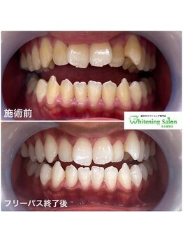 ホワイトニングサロン 名古屋駅店/【ホワイトニング施術例】