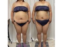 アンジュ(Ange)の雰囲気(凹凸脂肪に強い!引き締めのEMSつき/落ちなくなってきた脂肪に)