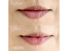 パールピーチ(total beauty place pearl peach)/メラニンケア☆