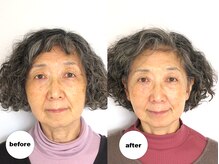 グランルーツ(GranRoots)/小顔矯正before/after