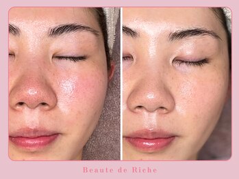 ボーテドリッシュ(Beaute de Riche)/リアボーテ美白フェイシャルB→A