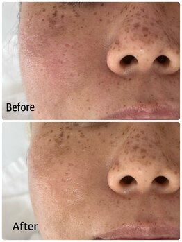 ベルエクラ(Bel Eclat)/【地肌免疫力アップ】初回/那覇