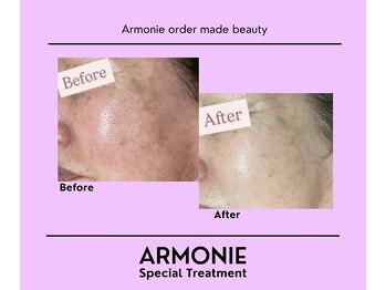 アルモニー(armonie)/エクソソームフェイシャル