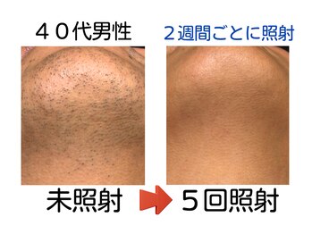 エビアス 旭川豊岡(evias)/メンズ店 5回でヒゲがこんなに！