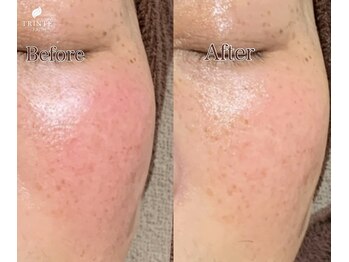 トリンテ バイ フェース(TRINTE by FAITH)/【プラチナムフルコース】1回