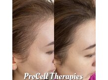 ジョアン(Johan)/プロセル★頭皮