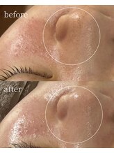 サロンナナジュウニ(Salon72)/黒ずみ/毛穴