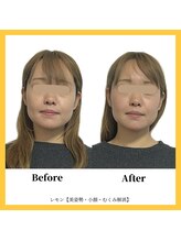美容整体 レモン/スッキリ小顔効果