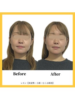 美容整体 レモン/スッキリ小顔効果