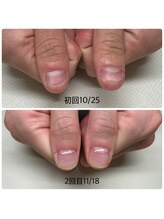 エヌスタイル(N-STYLE)/深爪改善ケア